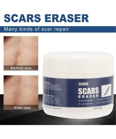 Scar Gel - Skin Repair and Removal Treatment for Face, Body, Surgery, Burns, Stretch Marks - Buy Online on GoSupps.com