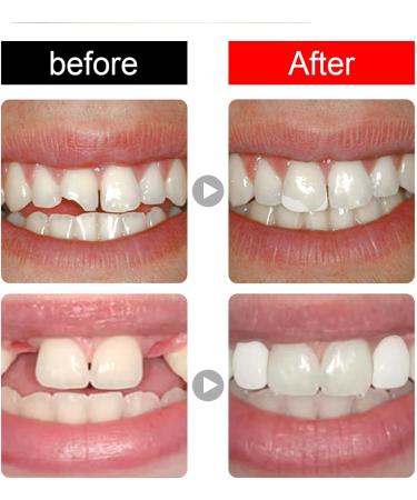 Tooth Repair Kit - Dentures Dental Adhesive Set | Temporary Veneers & Tooth Filling for Perfect Smile - Buy Online on GoSupps.com