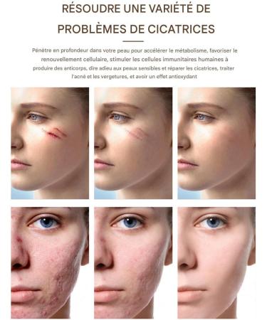 Scars Removal Cream Natural Moisturizing Skin Care Products 30g - Body & Skin Cream | For Morning Day Night Face Body Travel Home Piercing Cicatri Brands - Buy Online on GoSupps.com