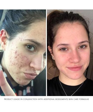 Bioelements Acne Toner | 0.5% Salicylic Acid | Vegan Gluten Free Fragrance Free | 3 fl oz | International Shipping Available - Buy Online on GoSupps.com