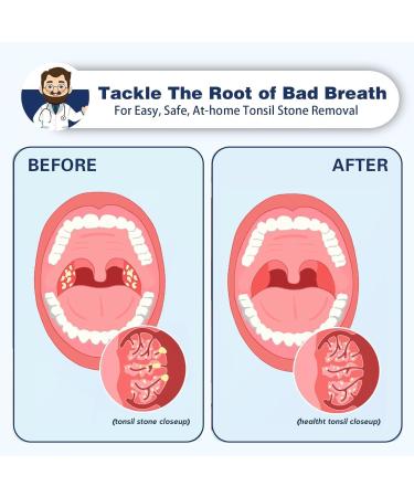 Tonsil Stone Remover | Clean & Fight Bad Breath | Oral Irrigator Tool for Stone Removal - International Shipping - Buy Online on GoSupps.com