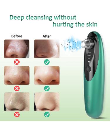 Blackhead Remover Pore Vacuum with Camera - Rechargeable Blackhead Suction Tool for Face and Nose - Skin Acne Pimple Cleaner for Men and Women - Buy Online on GoSupps.com