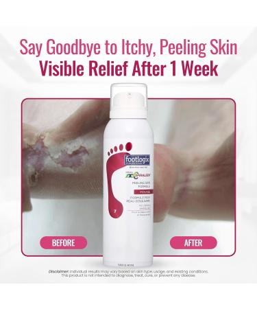FOOTLOGIX Peeling Skin Formula with Spiraleen, 4.23 oz - Buy Online on GoSupps.com
