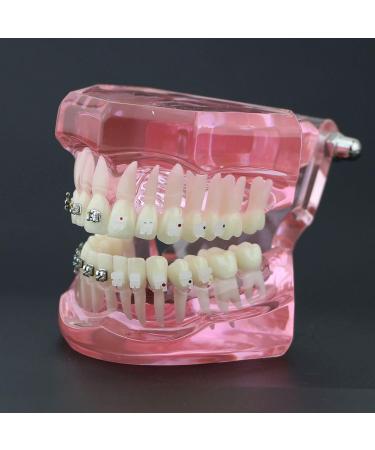 Buy Dental Orthodontic Teeth Model with Metal & Ceramic Brackets - Ideal for Study & Research | International Shipping Available - Buy Online on GoSupps.com