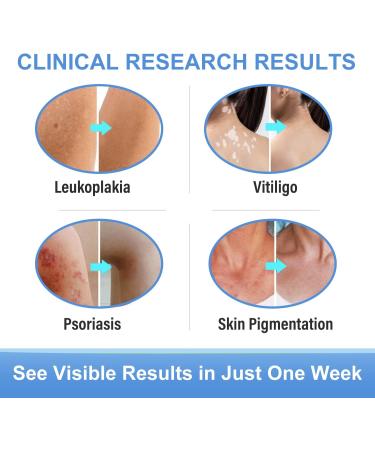 Vitiligo Cream for Skin Treatment and Pigmentation Care - Buy Online on GoSupps.com