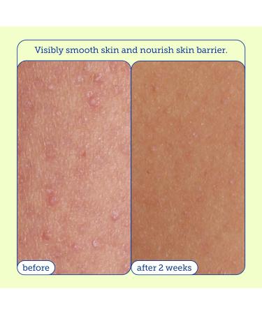 Skinfix Resurface+ AHA/BHA Renewing Cream - Exfoliating & Moisturizing Body Cream for Rough Bumpy Skin | 10 Fl Oz - Buy Online on GoSupps.com