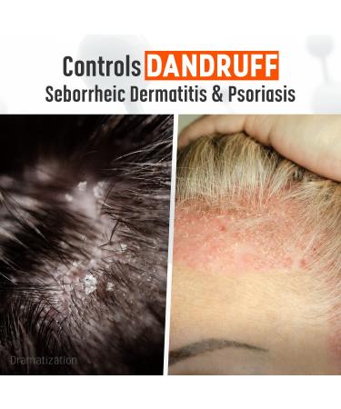 Medicasp Coal Tar Gel Dandruff Shampoo 6oz - Seborrheic Dermatitis & Psoriasis Treatment - Buy Online on GoSupps.com