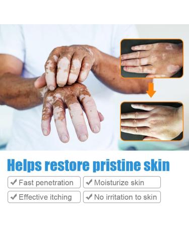 EXQST Vitiligo Care Cream - Targeted Treatment for Even Skin Tone - Buy Online on GoSupps.com