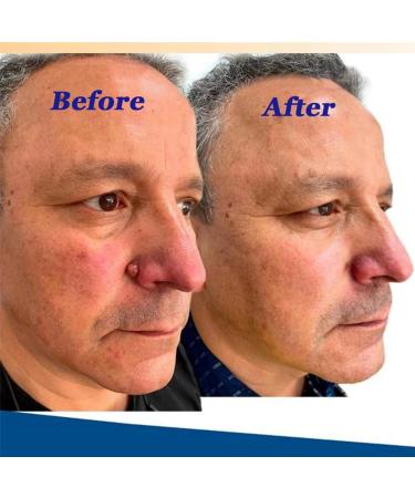 Skin Tag and Mole Removal Lotion - Fast-Acting Natural Remover for Warts - Easy Home Treatment (2PCS 40ML) - Buy Online on GoSupps.com