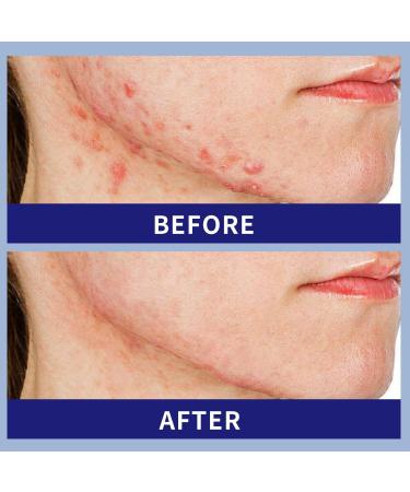 Moisturizing Salicylic Acid Face Cream Hydrating Salicylic Acid Cream For Face Alicylic Acid Face Cream For Oily Skin 20g 0.7oz - Buy Online on GoSupps.com