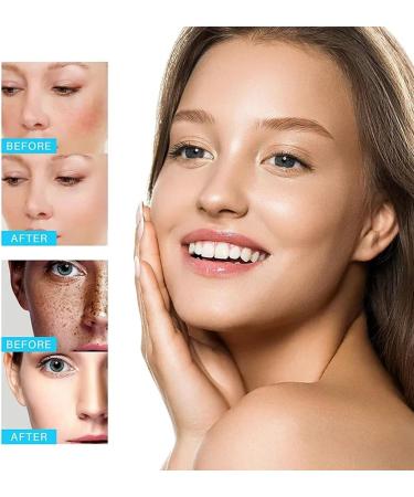 Dark Spot Remover for Face Melasma Treatment for Face Dark Spot Corrector Spot Cream Hyperpigmentation Treatment Sun Spots and Melasma Freckle Remover with Vitamin C Glycerol Even Skin Tone - Buy Online on GoSupps.com