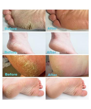 Urea 40 Foot Cream with Salicylic Acid - Best Callus Remover for Dry Cracked Heels - Buy Online on GoSupps.com