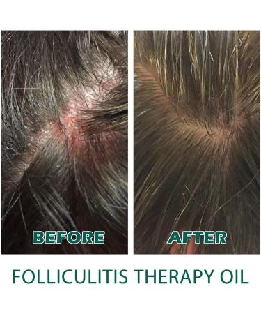 DUBUSH 2023 New scalp folliculitis therapy oil natural scalp therapy hair oil nourishing treatment oil for split ends and dry scalp for hair growth and skin care - Buy Online on GoSupps.com
