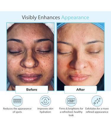 Glycolic Acid 50% Gel Peel - Enhanced with Retinol & Green Tea Extract (Professional Skin Peel)1 ounce 50% Strength - Buy Online on GoSupps.com