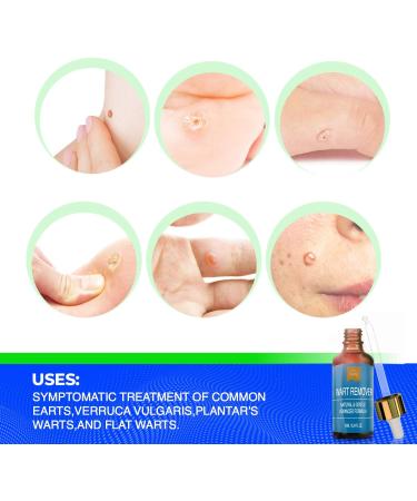 Liquid Wart Remover | Fast-Acting Advanced Treatment for All Wart Types - Painless Solution for Common & Genital Warts - International Shipping Available - Buy Online on GoSupps.com