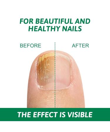 30ml Fast-Acting Toenails Treatment - Strengthen & Protect Brittle Nails | No Filing Needed - Buy Online on GoSupps.com