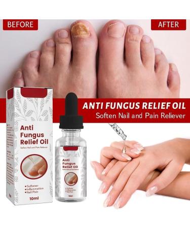 TBeautfave Fungal Nail Treatment Antifungal Nail Treatment Toe Nail Fungal Treatment Fungal Nail Treatment for Toenails Extra Strong Nail Repair and Strengthen Fix & Renew Damaged Broken Nails - Buy Online on GoSupps.com