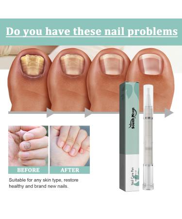 Nail Care Pen Set - 6 Pieces for Nail Fungus Treatment | Fast Growth & Healthy Nails with Aloe Vera Tea Tree Oil & Vitamin E - Buy Online on GoSupps.com