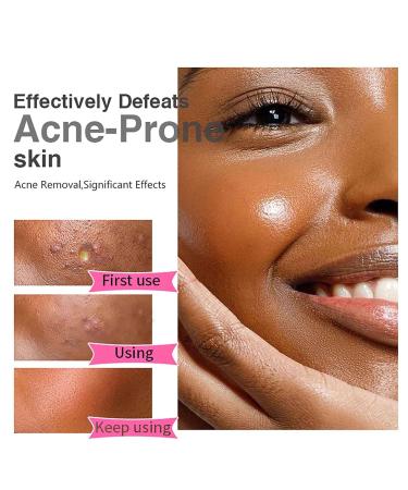 Salicylic Acid Acne Spot Removal Cream - Control Breakouts Clear Pimples & Blackheads | 1.76 oz Refreshing Formula for Acne-Prone Skin - Buy Online on GoSupps.com