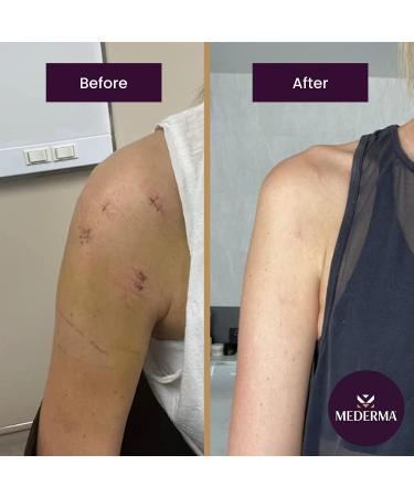 Mederma Advanced Scar Gel - 1x Daily Treatment for Old & New Scars - 1.76oz - Doctor & Pharmacist Recommended - Clear - 100g - Buy Online on GoSupps.com