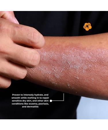 Intensive Moisturizing Cream 8oz (226g) Deep Hydration & Repair for Dry Sensitive Skin | Soothes Eczema Psoriasis Dermatitis & More Nourishing Non-Greasy Formula. - Buy Online on GoSupps.com