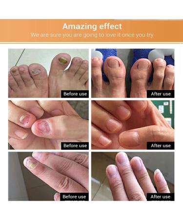 Fungal Nail Treatment Essence - Extra Strong Nail Repair Solution for Fingernails & Toenails - Buy Online on GoSupps.com