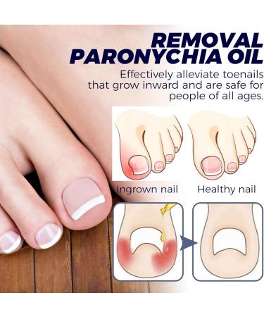  LWuuywa German Toenailplus Anti-Paronychia Relief Oil 10ml Correction Treatment Oil Nail Care Nail Growing Anti-Paronychia Aid Oil Ingrown Nail Drops - Buy Online on GoSupps.com