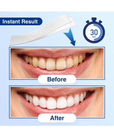 Sensitivity-Friendly Teeth Whitening Strips | 28 Effective Whitener Strips for Reduced Sensitivity | Removes Stains from Smoking, Coffee, Soda, & Wine | 14 Treatments - Buy Online on GoSupps.com