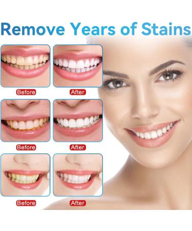 Teeth Whitening Pen 3 Packs - Painless Whitening for Sensitive Teeth - Mint Flavor | Safe & Effective - Buy Online on GoSupps.com