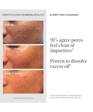 Murad Acne Control Clarifying Cleanser Salicylic Acid & Green Tea Formula for Acne Deep Pore Cleansing Oil Control & Breakout Prevention for Clear Balanced Healthy-Looking Skin 5 Fl Oz (Pack of 1) - Buy Online on GoSupps.com