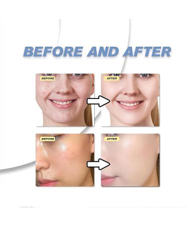 Azelaic Acid Acne Cream for Face Azelaic Acid With Hyaluronic Acids for Face Redness Smooth Anti Acne Breakouts Azelaic Acid Serum Balance Excess Oil & Soothing No Irritation - Buy Online on GoSupps.com