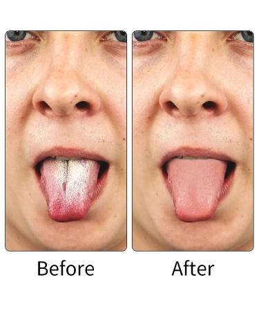 3 Pcs Stainless Steel Tongue Scraper Set - Oral Care Metal Tongue Cleaner for Fresher Breath - Adults & Kids - Buy Online on GoSupps.com