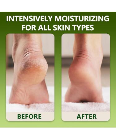 IZBEAUVO Tea Tree Oil Foot and Hand Cream 150ML Foot Cream For Very Dry Feet Cracked Heel Repair Cream Tea Tree Cream Intensive Moisturizer Heel Balm For Cracked Heel Softens Feet&Hand&Knee - Buy Online on GoSupps.com