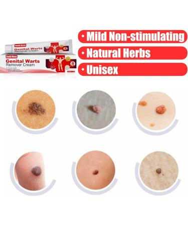 Fast Acting Cream Wart Remover - Maximum Strength Relief for Plantar Genital Common & Flat Warts - International Shipping Available - Buy Online on GoSupps.com