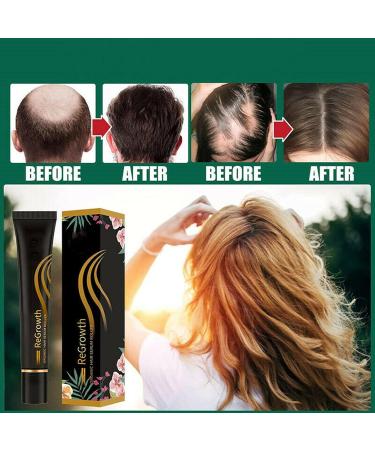 20ml Organic Hair Regrowth Serum Roller Set | Herbal Scalp Intense Roll-On for Men & Women | Triple Massager Hair Growth Essence (3PCs) - Buy Online on GoSupps.com