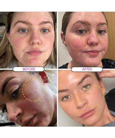 Clear Skin Days 4% BHA & 4% PHA Pore Refining Solution - Liquid Exfoliant Serum for Reduced Pore Appearance Breakout Prevention & Blackhead Control - Acid Combination Treatment - 50ml - Buy Online on GoSupps.com