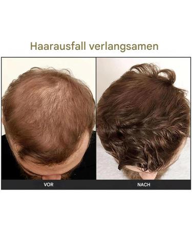  Generisch Hair Growth Oil Hair Growth Oil 50ml Scalp and Hair Strengthening Oil | Scalp Moisturizing Cream for Thick Hair Oil - Buy Online on GoSupps.com