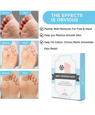 Wart Remover Plasters for Hands & Feet - Corn & Verruca Removal - Plantar Warts & Callus Treatment - 24pcs - Buy Online on GoSupps.com