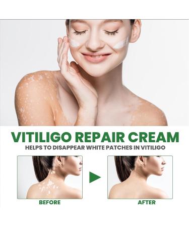 Vitiligo Care Set: Fix Revitalize Elixir & Soothing Moisturizer Cream - Reduce White Spots on Body - 2pcs - Buy Online on GoSupps.com