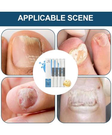 Croissance des Ongles - 4 Pi ces Stylo De Soin Pour Les Ongles Liquide R parateur Pour Des Pieds Secs - pour Maison Voyage Spa Manucure P dicure Salon Adultes Femmes Hommes - Buy Online on GoSupps.com