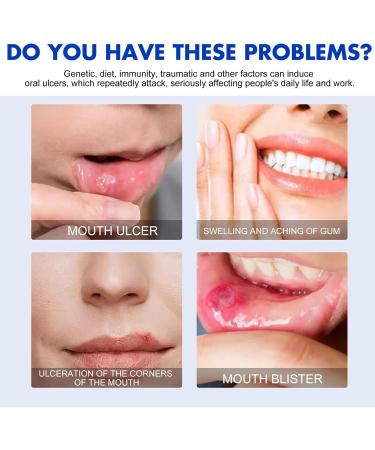 Mund Ulcers Spray - 30ml Mouth Spray for Gum Pain Relief | Refreshing Mint Taste | Fast-Acting Relief for Women and Men - Buy Online on GoSupps.com