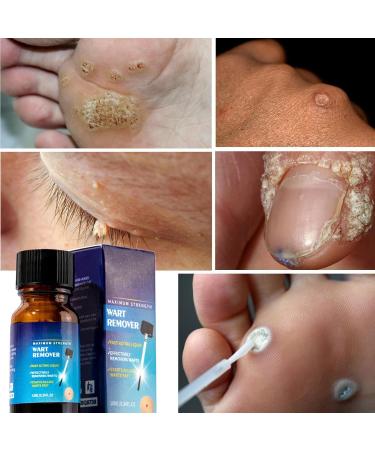Skin Spot Removal | 10ml Solution for Dissolving Mole Daily Beauty Care for Face Legs Feet Arms Home and Travel Men Women - Buy Online on GoSupps.com