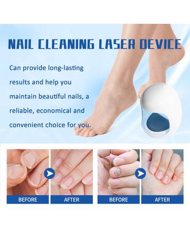 Fivfivgo Light Therapy Device for Nail Fungus Revolutionary Highly Efficient Light Therapy Device for Toenail Diseases Portable Device for Cleaning and Care of Nails - Buy Online on GoSupps.com