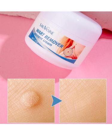 Wart Remover Cream Fast Acting Ointment Anti Corn Cream for Warts Plantar Warts Common Warts Flat Warts Warts for Feet Toe Finger Hands - Buy Online on GoSupps.com