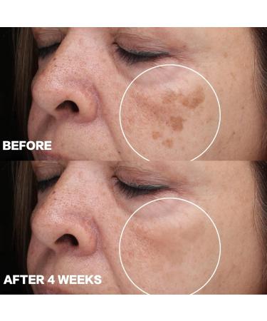 Dark Spot Remover for Face Dark Spot Corrector Cream Hyperpigmentation Melasma Freckle Sun Spots Removal for All Skin Types Dark Spot Corrector for Men and Women-1.7 fl oz - Buy Online on GoSupps.com