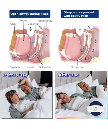 Sleep Mouth Strips - Gentle Nasal Breathing Aid for Better Sleep Quality - Reduce Mouth Breathing & Snoring (60pcs) - Buy Online on GoSupps.com