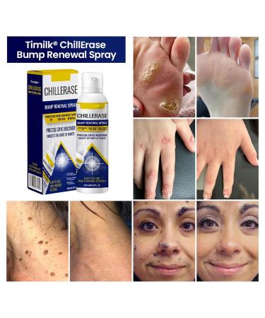 Sialicess ChillErase Bump Renewal Spray Soothing and Cooling Formula Advanced Salicylic Acid Body Spray 2% Natural Skin Spray-60ml Suitable for All Skin Types - Buy Online on GoSupps.com