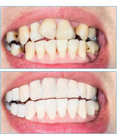 Jiazhou Hub 2 Pairs Prostheses - High-Quality Fake Teeth & Immediate Veneers for a Stunning Smile - Buy Online on GoSupps.com