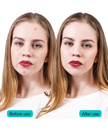 EUZUXU 40 Acne Patches Pimple Patch Waterproof Anti-Acne Pimple Patch Hydrocolloid Stickers for Pimples Invisible for Skin Care - Buy Online on GoSupps.com