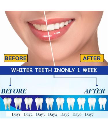SSKHE 28-Piece 9D Tooth Whitening Set - Professional Non-Sensitive Formula for Deep Stain Removal - Buy Online on GoSupps.com